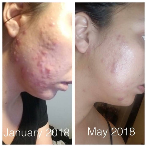 Butter Me Up Super Acne Fighter