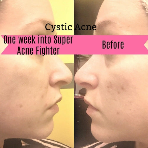 Butter Me Up Super Acne Fighter