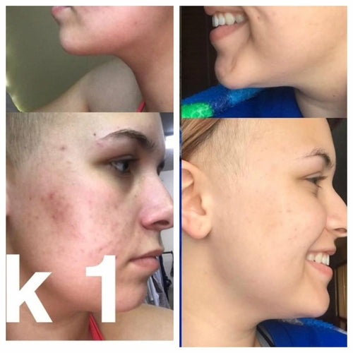 Butter Me Up Super Acne Fighter